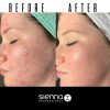 before and after chemical peel 1